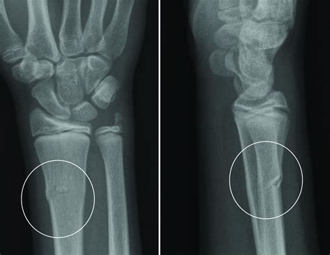 Buckle Fracture Raleigh Hand Surgery Joseph J Schreiber Md Buckle Fracture Raleigh Hand Surgery Joseph J Schreiber Md