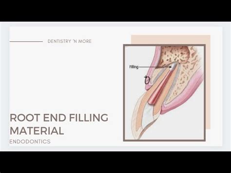 Root End Retrograde Filling Materials Youtube Root End Retrograde Filling Materials Youtube