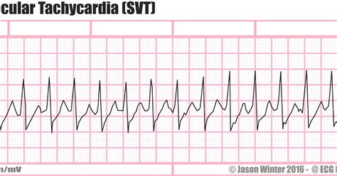 Tachycardia Icd 10