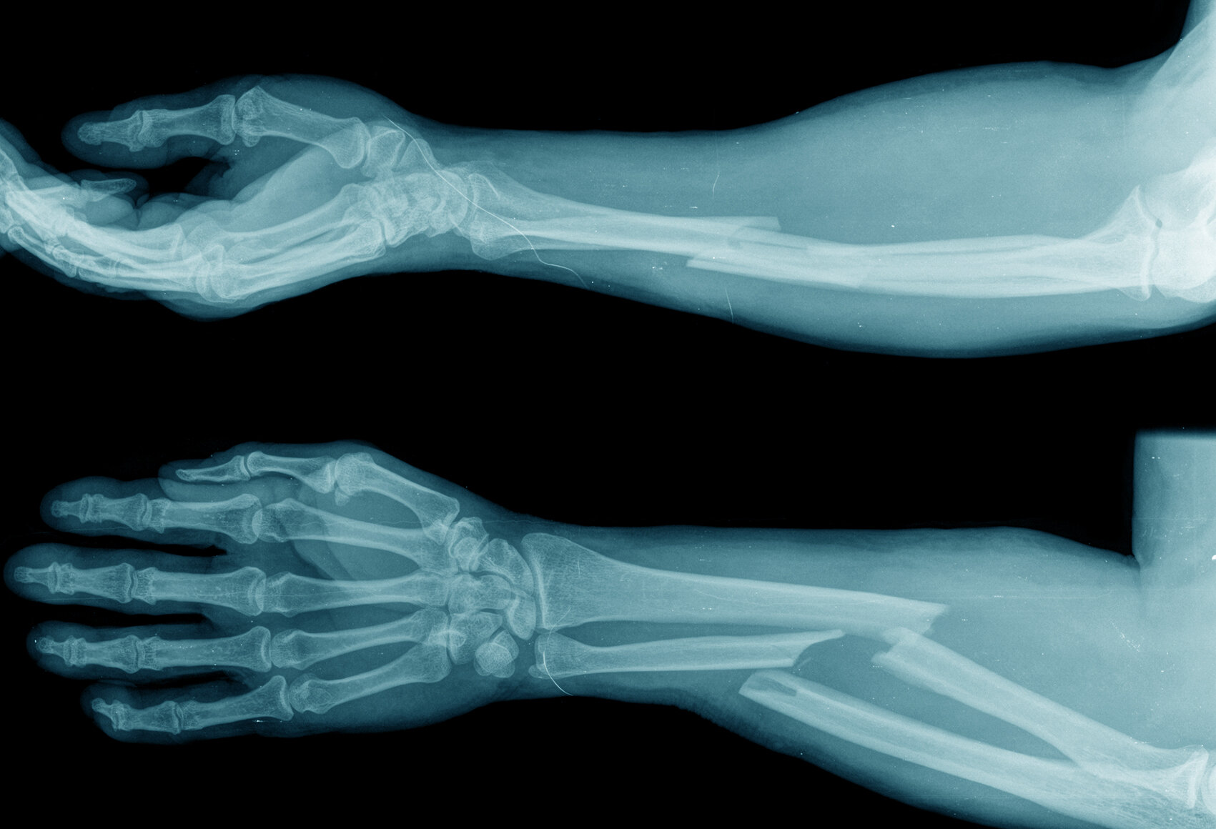 Trauma Treatment Of Fractures Orthopaedic Surgery Sports And Trauma Treatment Of Fractures Orthopaedic Surgery Sports And