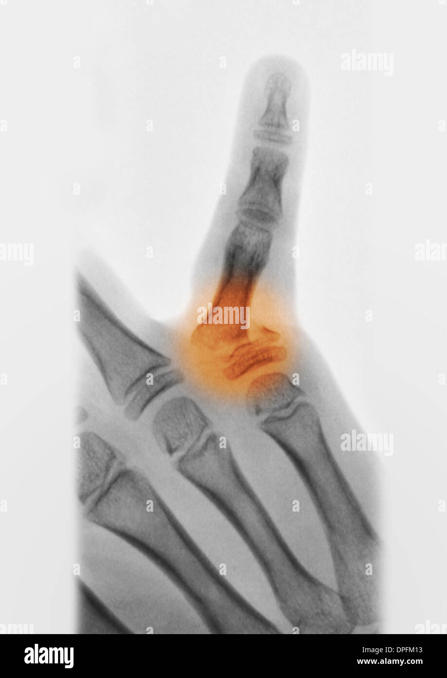 X Ray Hand Fracture Proximal Phalanx Hi Res Stock Photography And X Ray Hand Fracture Proximal Phalanx Hi Res Stock Photography And