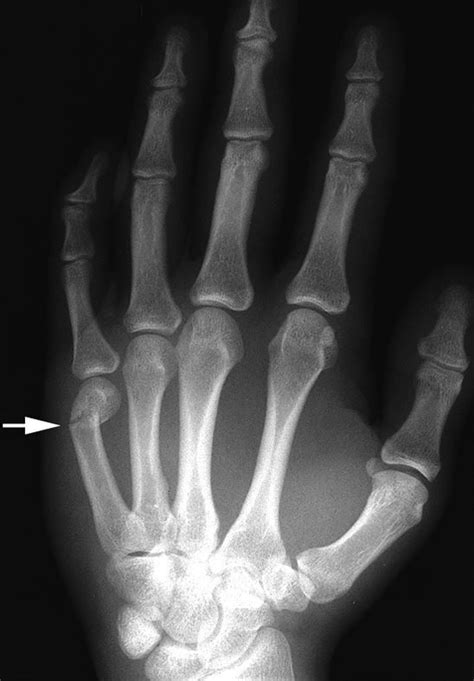 Xray Hand Fracture